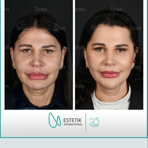 Estiramiento facial no quirúrgico Fotos del antes y el después